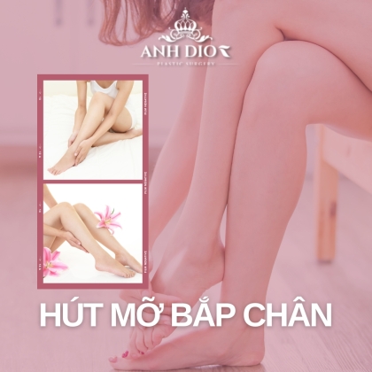 Hút mỡ bắp chân bao nhiêu tiền? [Kinh nghiệm & Bảng giá]